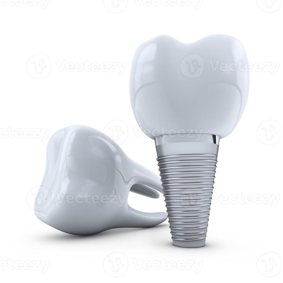 implante y molar foto