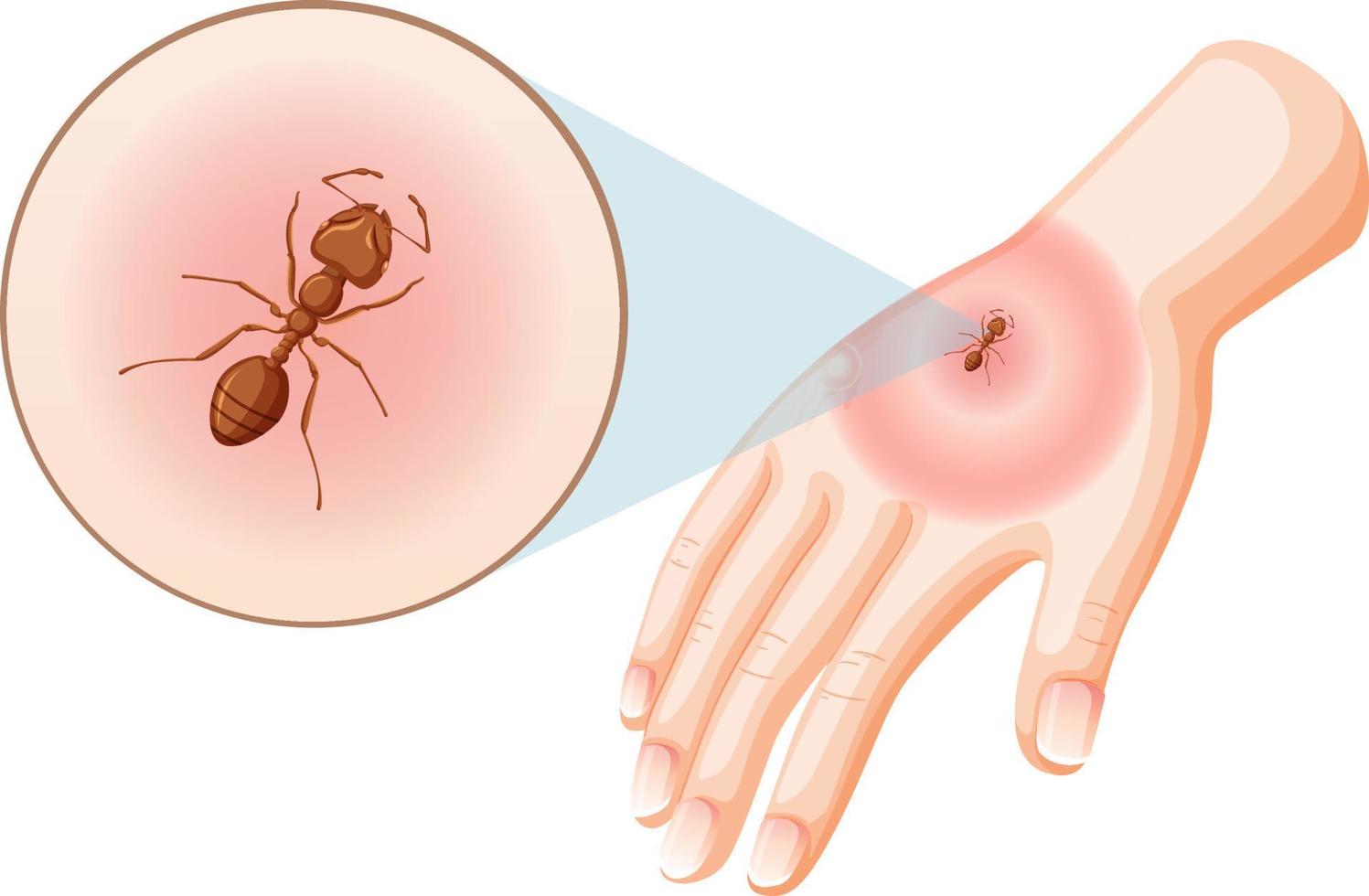 Ant bites sting on skin vector