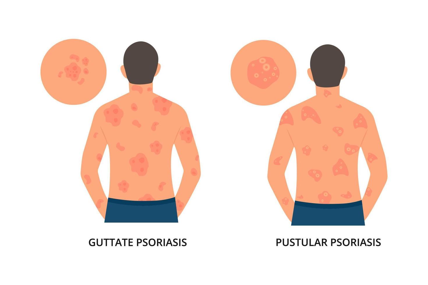 Man has allergic itching, skin inflammation, redness and irritation.Guttate,postular psoriasis.Atopic dermatitis, eczema, psoriasis, dry skin. Skin problems.isolated, vector. vector