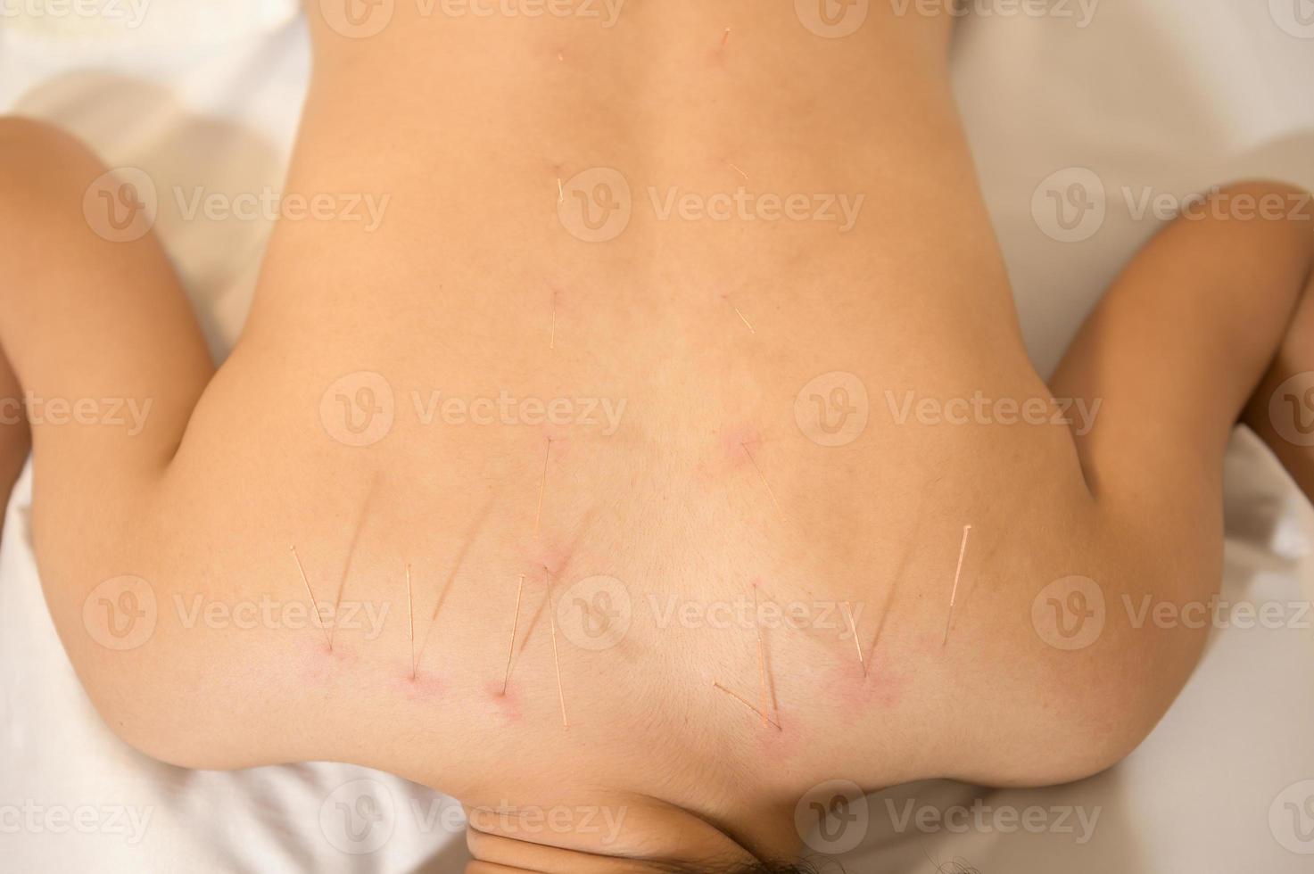 Beautiful Woman Received acupuncture treatment on back by  therapist, chinese medicine treatment, health and healing concept. photo