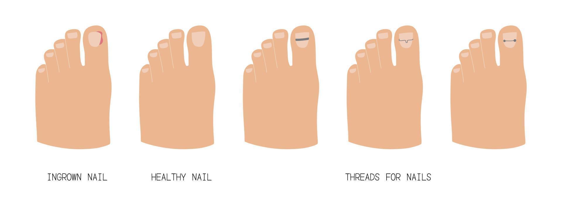 Treatment of ingrown toenail with titanium brackets different types. Hand drawn vector illustration