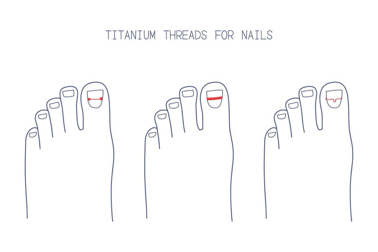 Treatment of ingrown toenail with titanium brackets different types. Hand drawn vector illustration