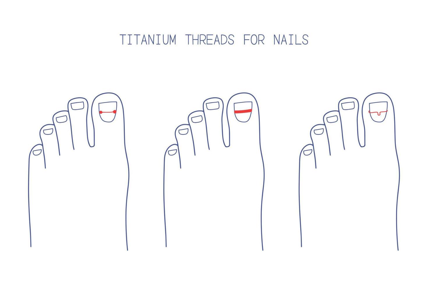 Tratamiento de uñas encarnadas con brackets de titanio de diferentes tipos. ilustración vectorial dibujada a mano vector