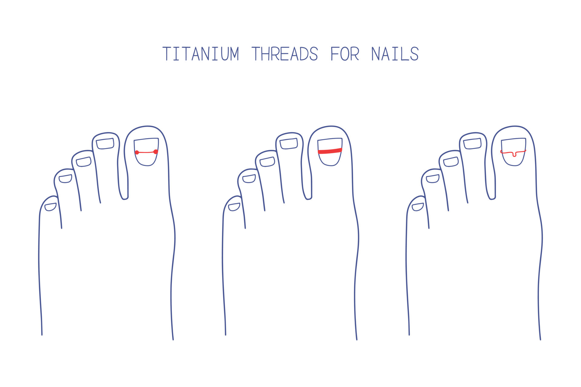 Treatment of ingrown toenail with titanium brackets different types