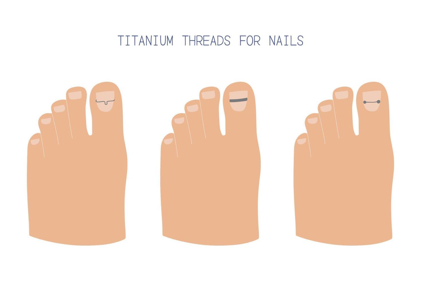 Treatment of ingrown toenail with titanium brackets different types. Hand drawn vector illustration