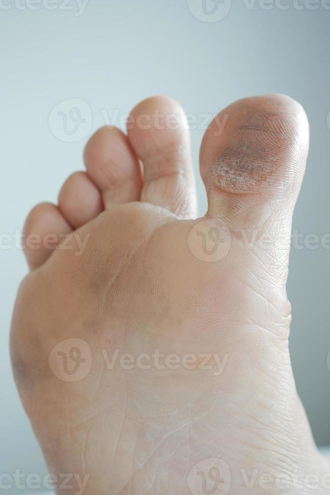 close up of young men dry feet on bed , photo