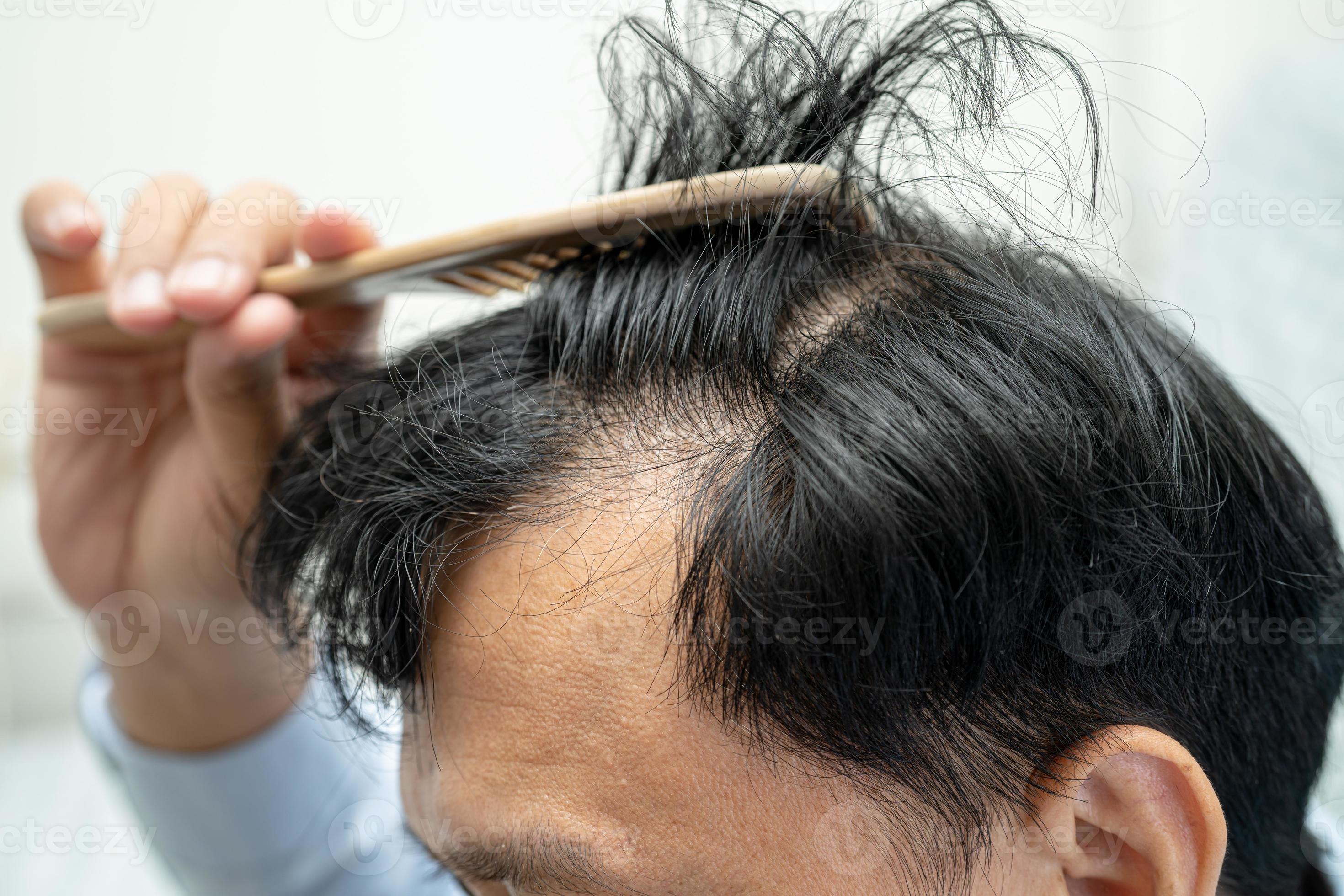 Bald in the middle head and begin no loss hair glabrous of mature Asian  business smart active office man. 12790879 Stock Photo at Vecteezy