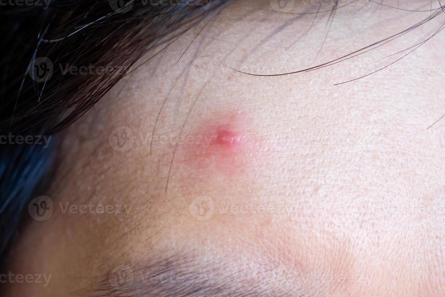 Inflammatory acne with red spot on face closeup photo
