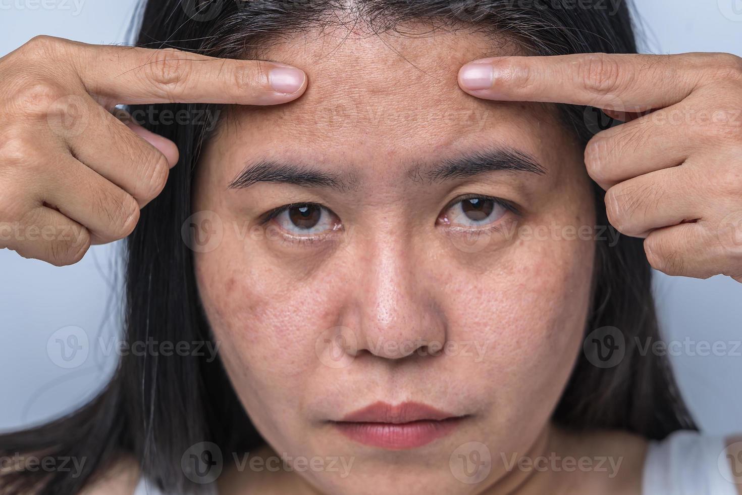 Asian adult woman face has freckles, large pores, blackhead pimple and scars problem from not take care for a long time. Skin problem face isolated white background. Treatment and Skincare concept photo