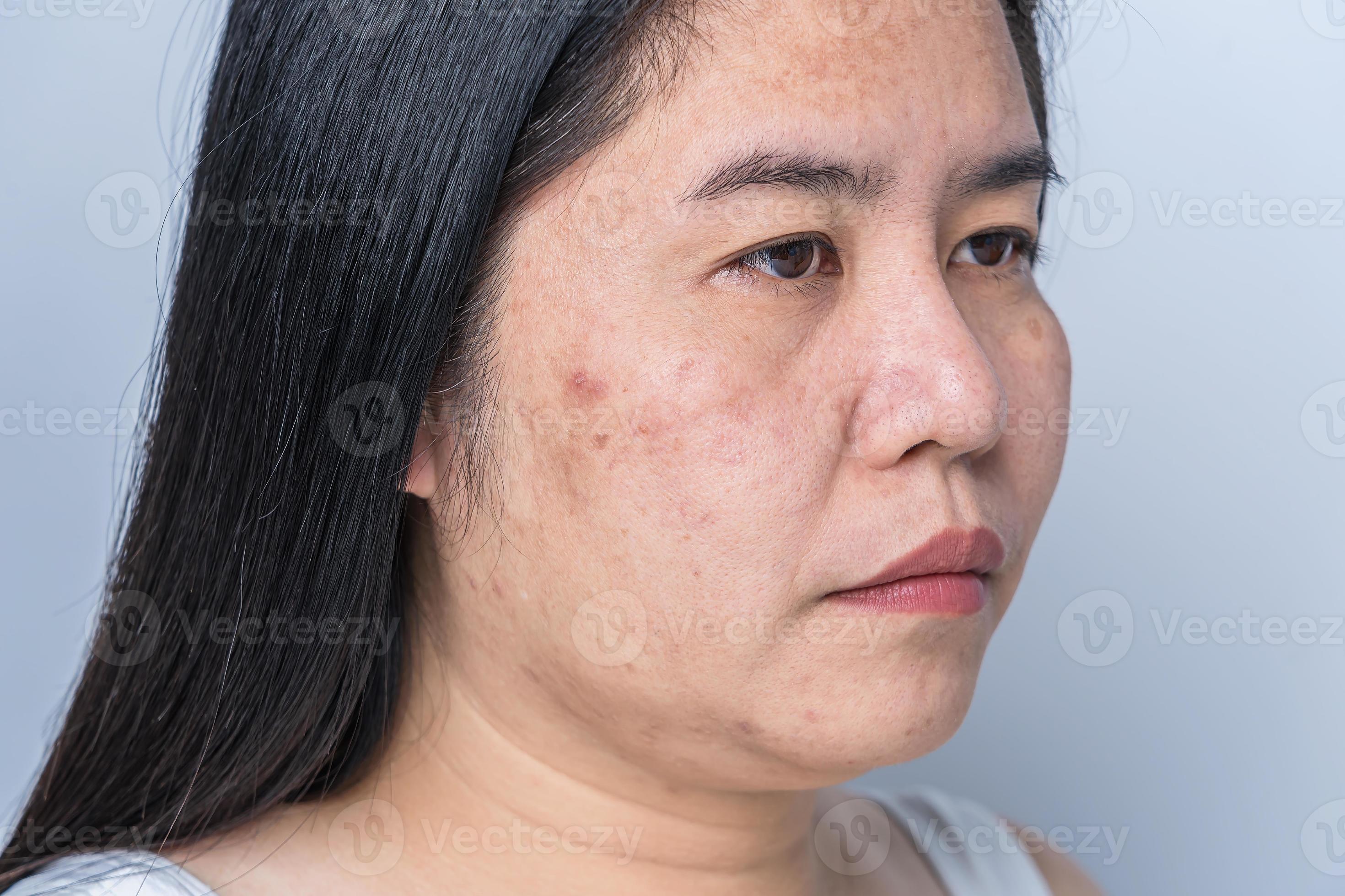 Big Blackhead Pimple - dfq4tej