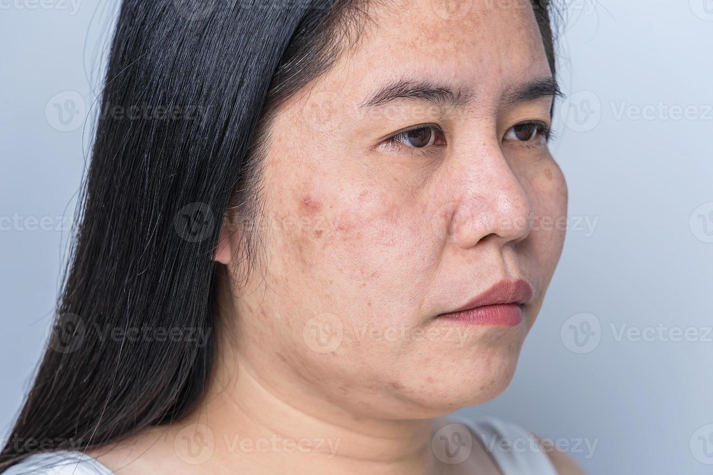 Asian adult woman face has freckles, large pores, blackhead pimple and scars problem from not take care for a long time. Skin problem face isolated white background. Treatment and Skincare concept photo