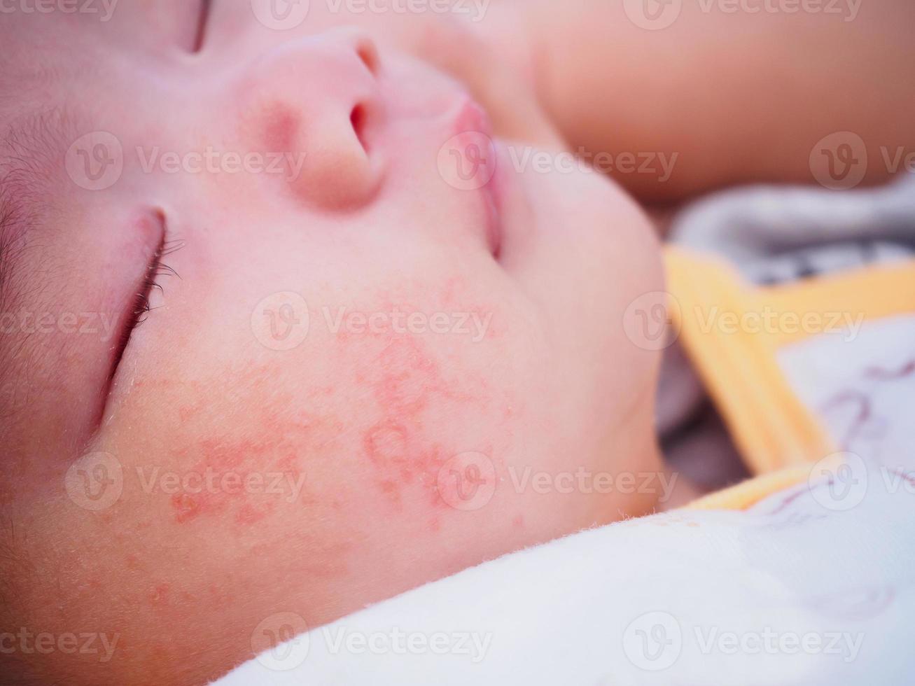 newborn baby with allergy on face photo
