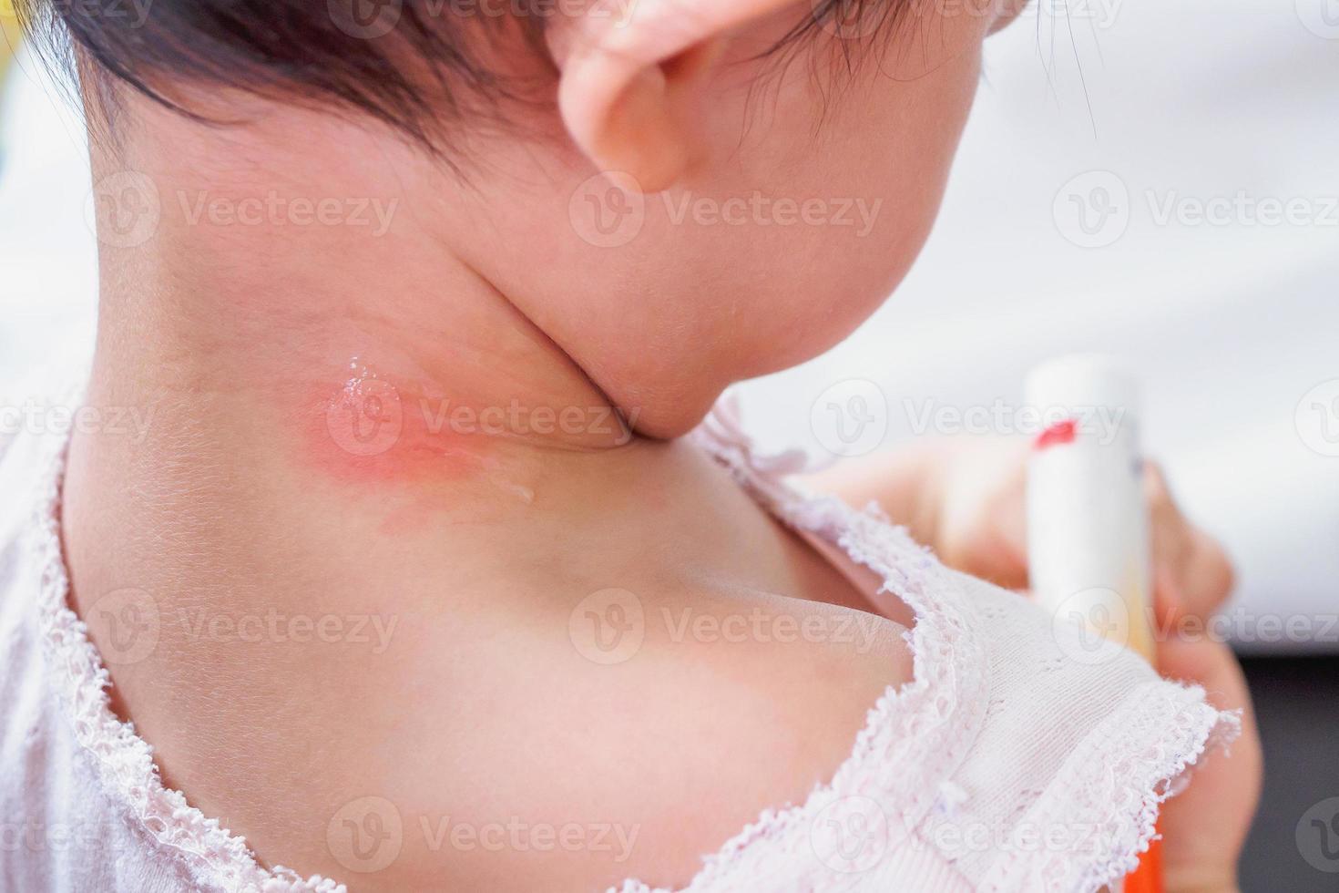 baby skin rash and allergy with red spot cause by mosquito bite at neck photo