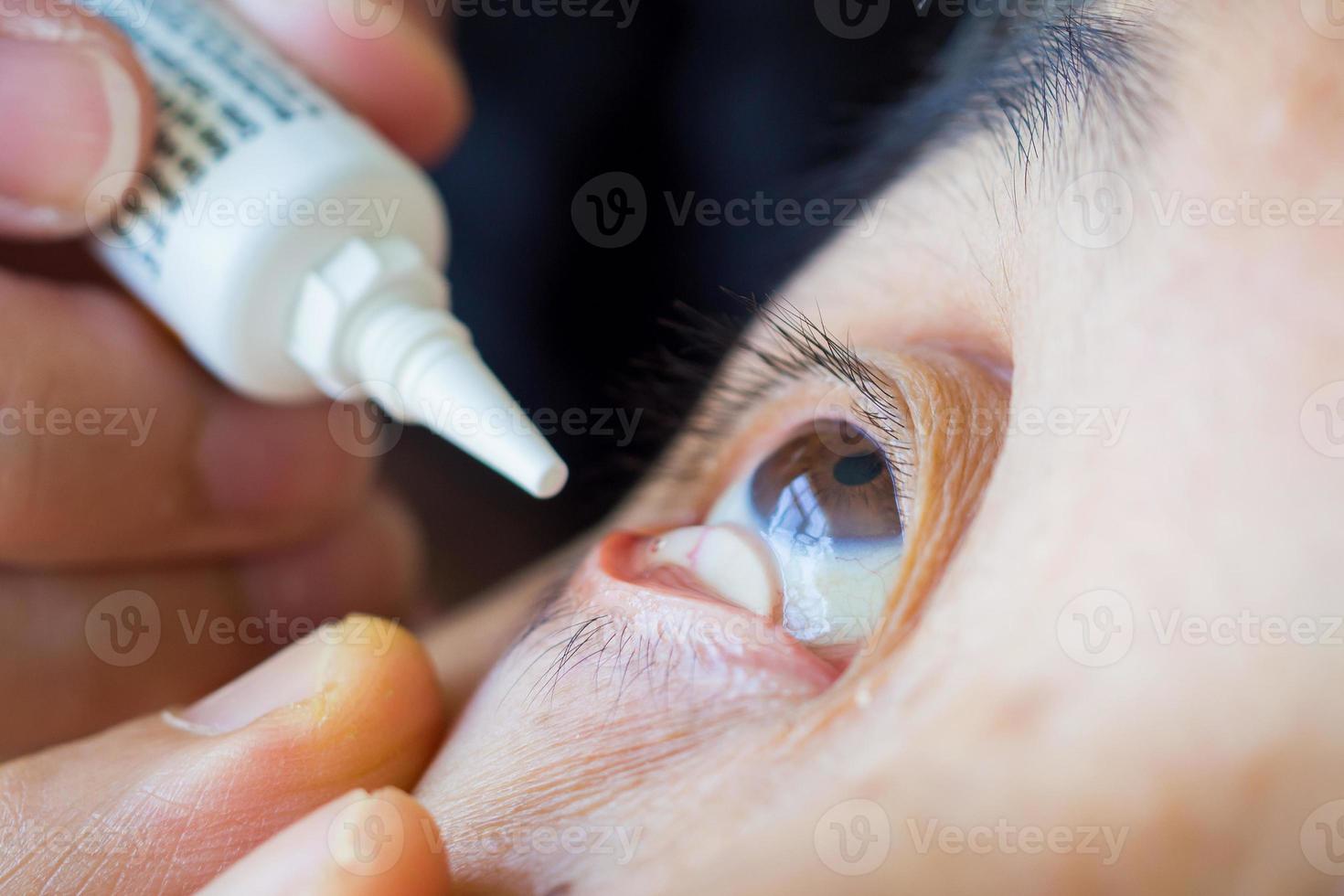 Doctor apply artificial tears gel to senior woman patient eye for treatment dry eye photo