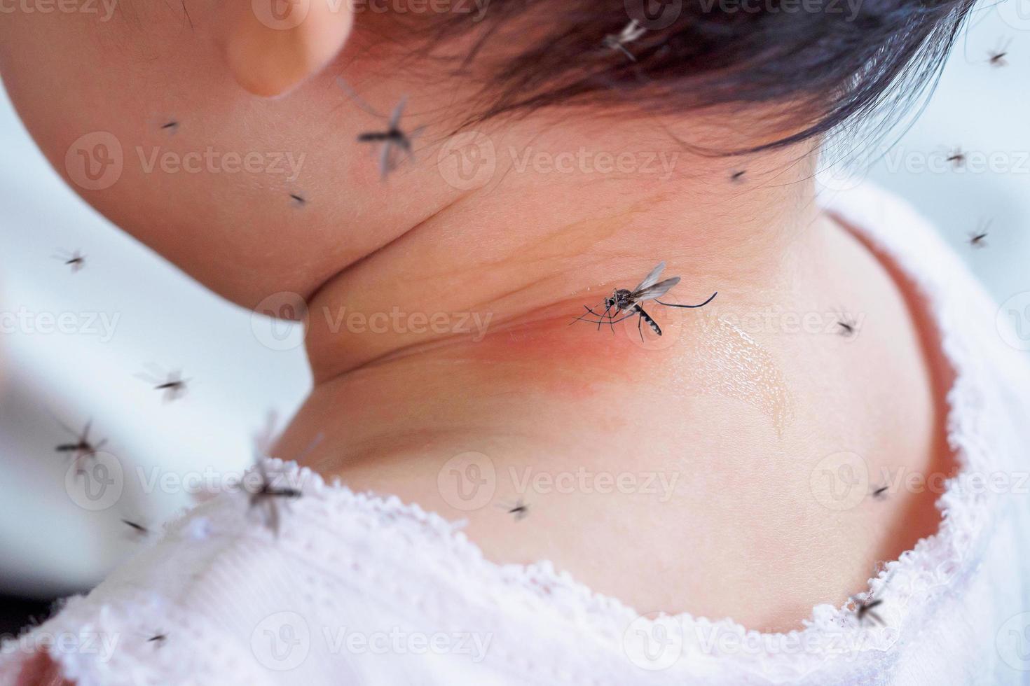 cute asian baby girl has rash and allergy on neck skin from mosquito bite and sucking blood photo