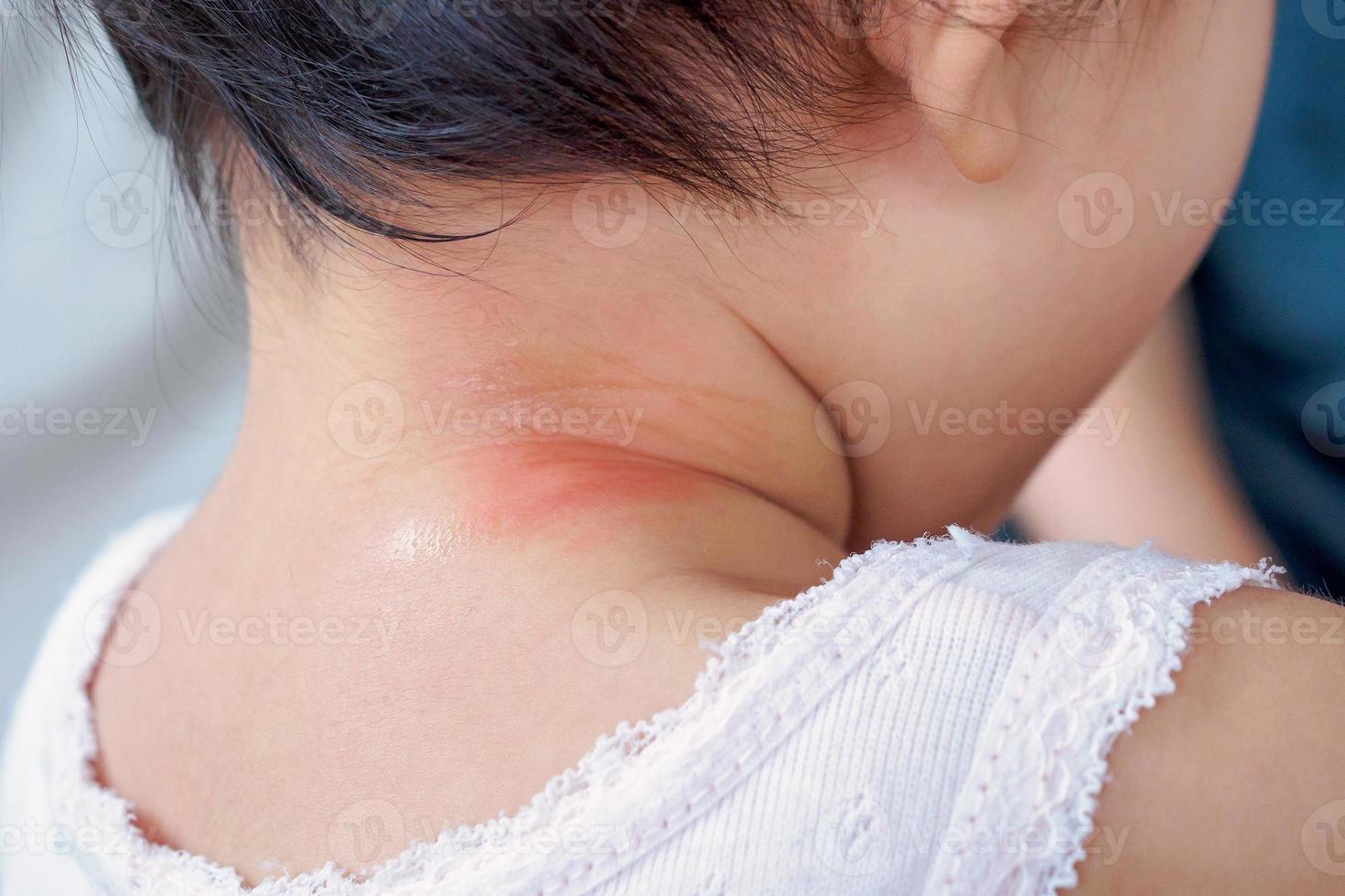 baby skin rash and allergy with red spot cause by mosquito bite at neck photo
