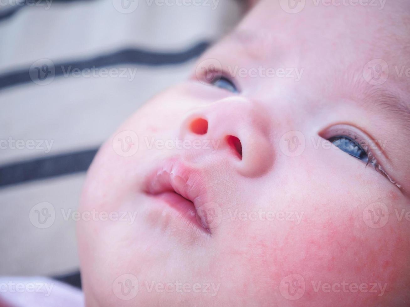 newborn baby with allergy on face photo