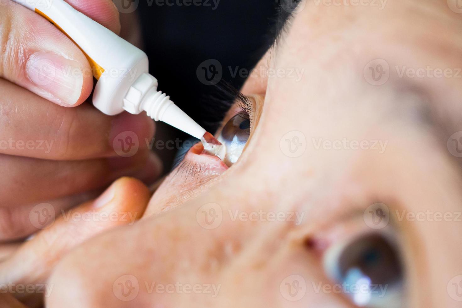 Doctor apply artificial tears gel to senior woman patient eye for treatment dry eye photo