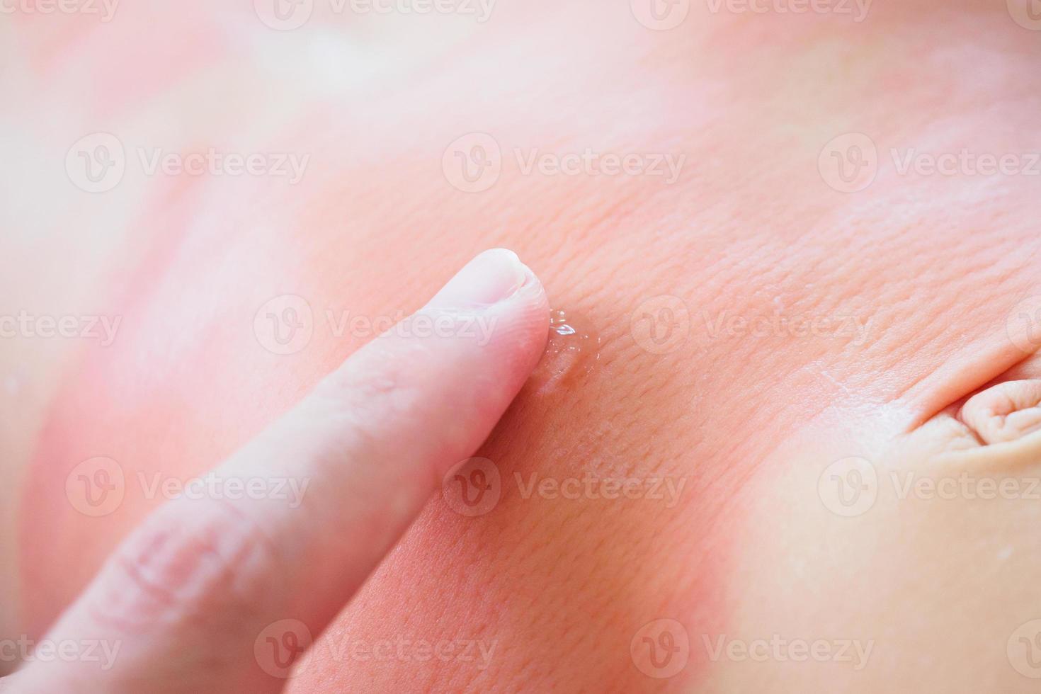 Doctor hand applying topical antihistamine medicine cream on little girl body with severe skin rash and allergy photo