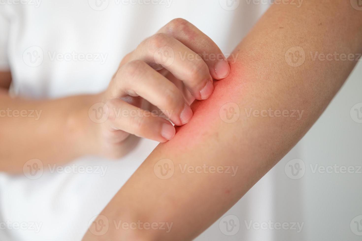 man itching and scratching on arm from itchy dry skin eczema dermatitis photo