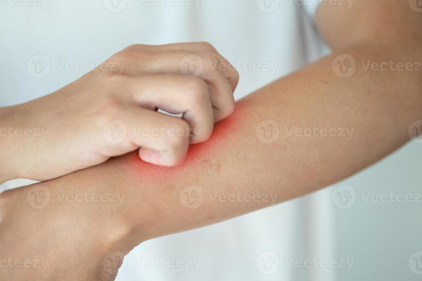 hombre picazón y rascado en el brazo por picazón en la piel seca eczema dermatitis foto