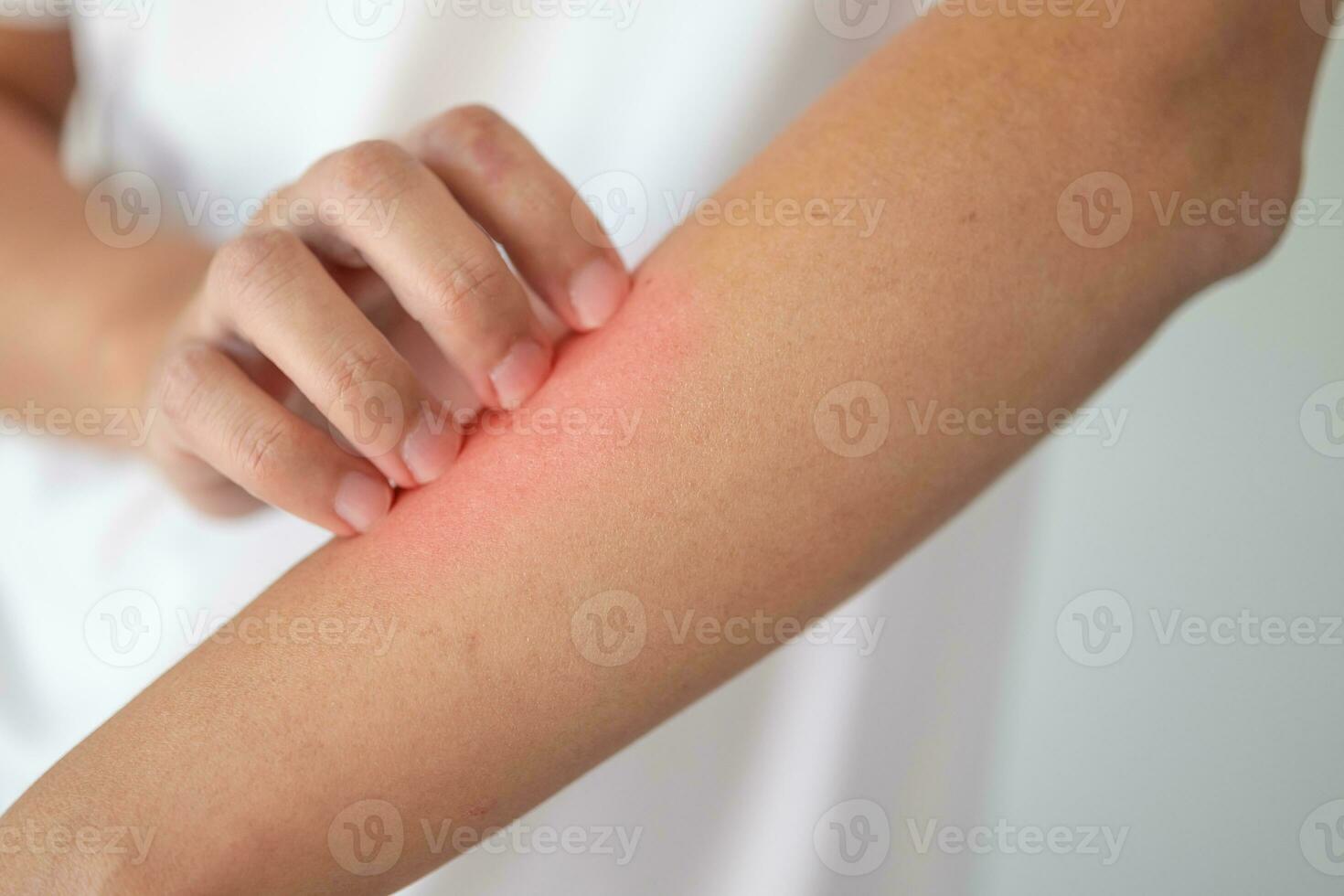 man itching and scratching on arm from itchy dry skin eczema dermatitis photo