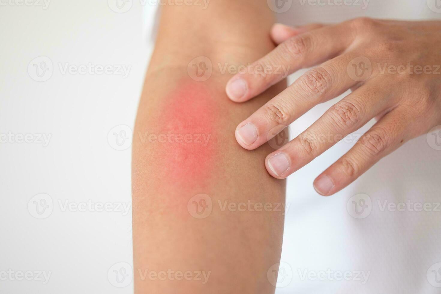 man itching and scratching on arm from itchy dry skin eczema dermatitis photo