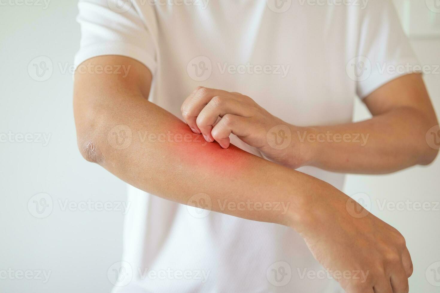 man itching and scratching on arm from itchy dry skin eczema dermatitis