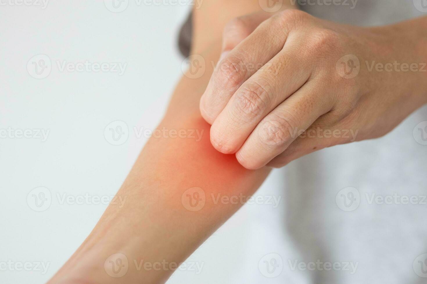 Young asian man itching and scratching on arm from itchy dry skin eczema dermatitis photo