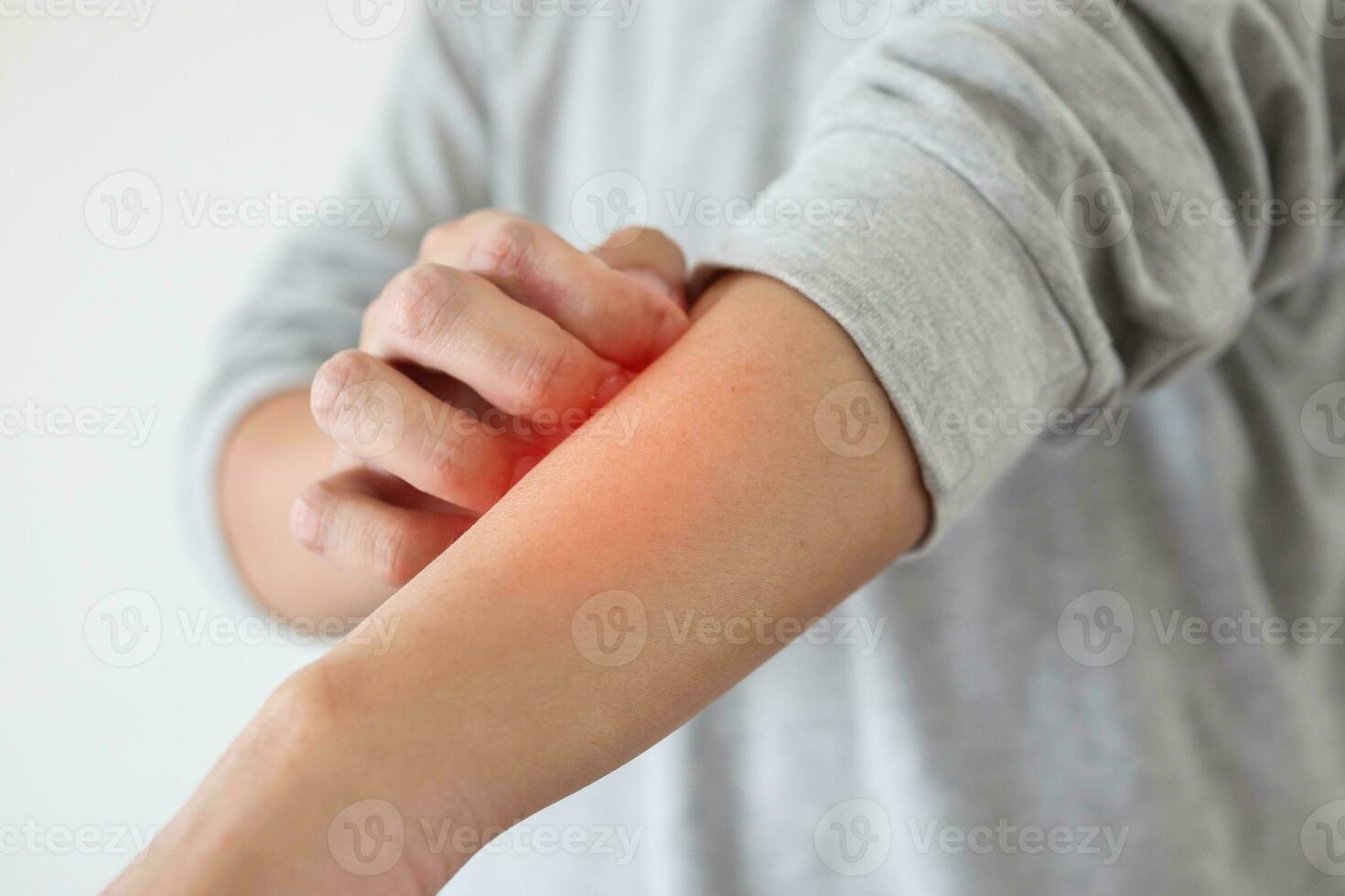 Young asian man itching and scratching on arm from itchy dry skin eczema dermatitis photo