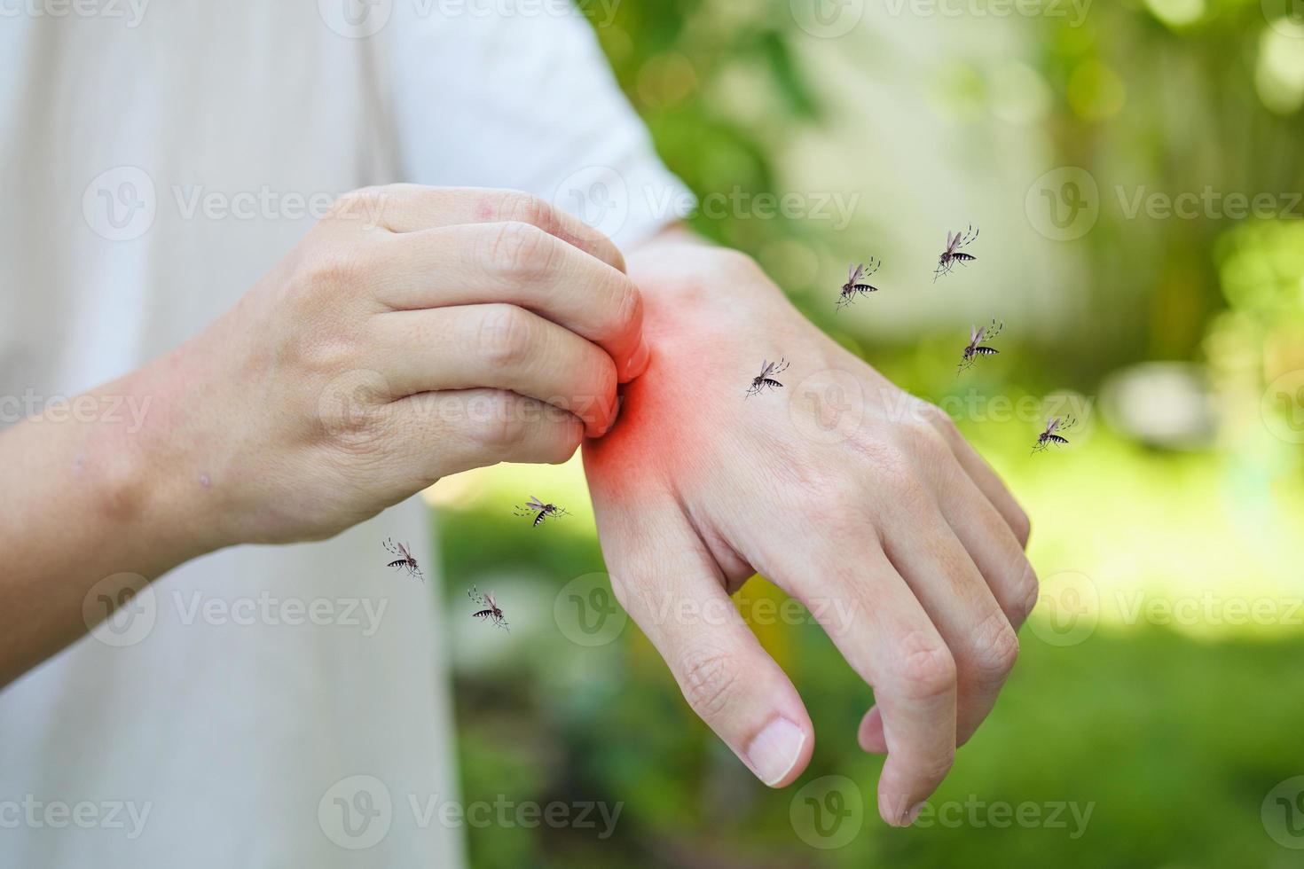 Man itching and scratching on hand from allergy skin rash cause by Mosquitoes bite photo