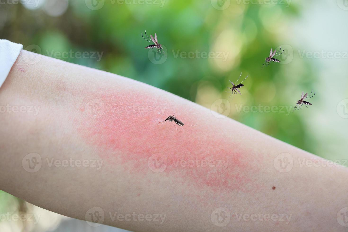 Mosquito bite on adult arm with skin rash and allergy with red spot photo