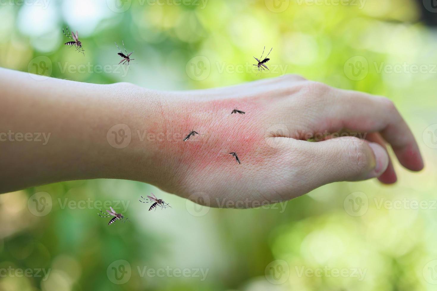 Mosquitoes bite on adult hand made skin rash and allergy with red spot
