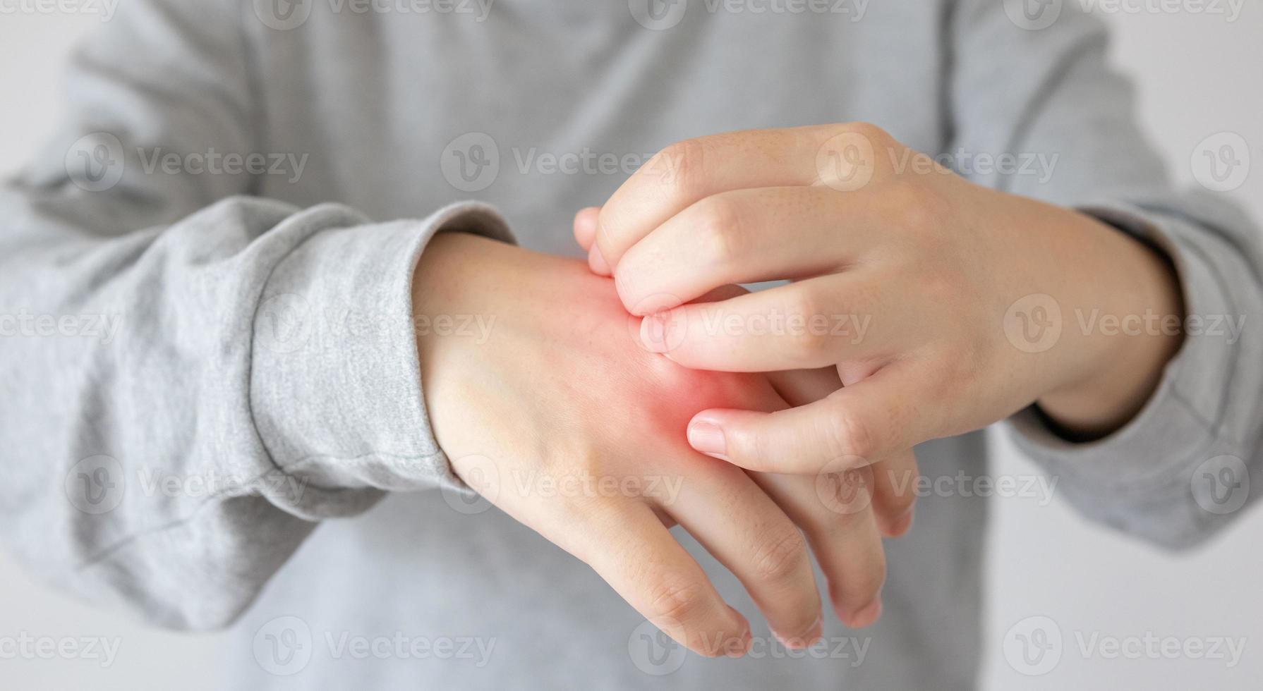 joven asiática picazón y rascado en la mano por dermatitis eczema de piel seca con picazón foto