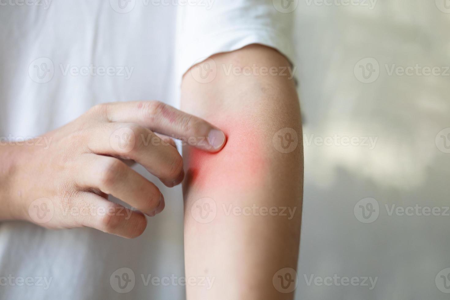 man itching and scratching on arm from insect bite or itchy dry skin eczema dermatitis photo