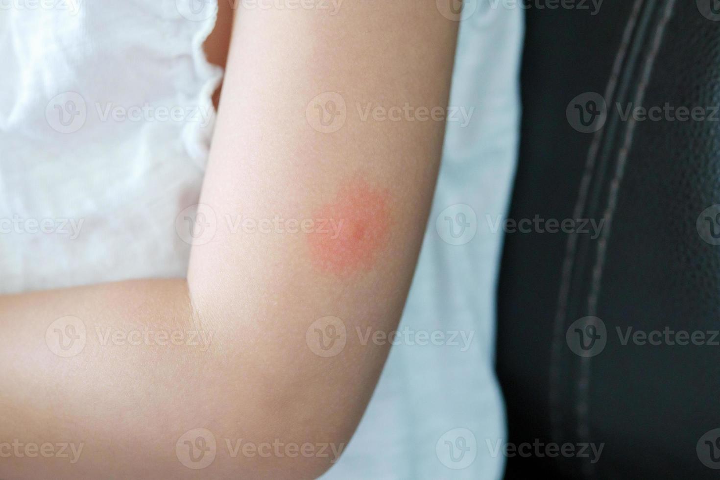 Little girl has skin rash and allergy from mosquito bite photo