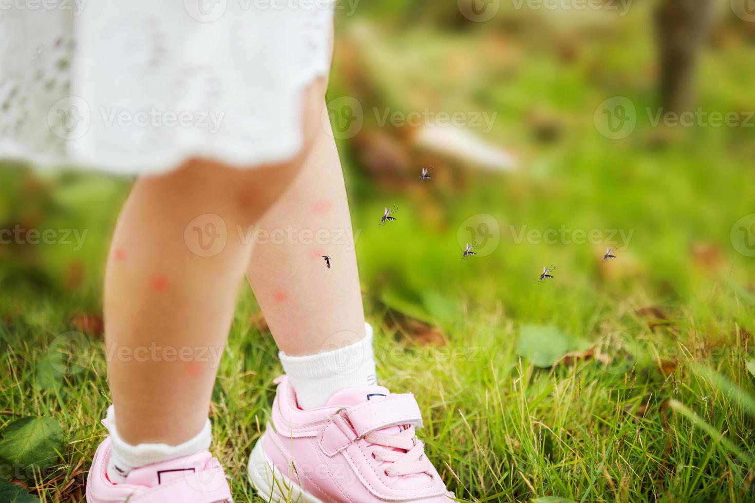 cute asian little girl has skin rash and allergy from mosquito bite and sucking blood at legs while playing on green grass field outdoor photo