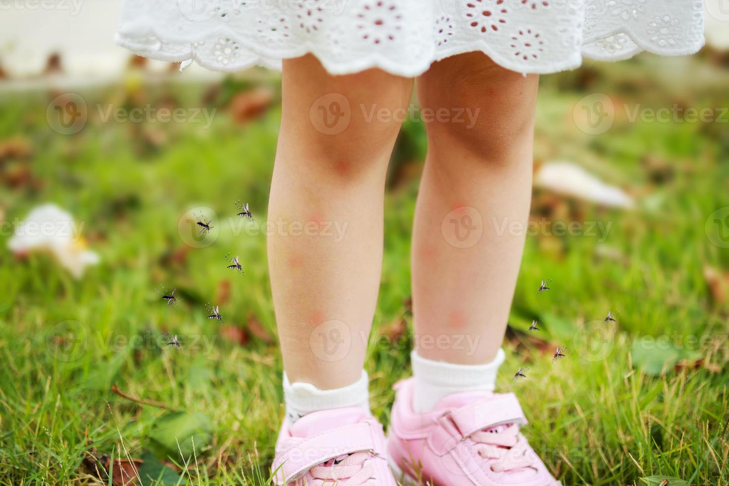 cute asian little girl has skin rash and allergy from mosquito bite and sucking blood at legs while playing on green grass field outdoor photo