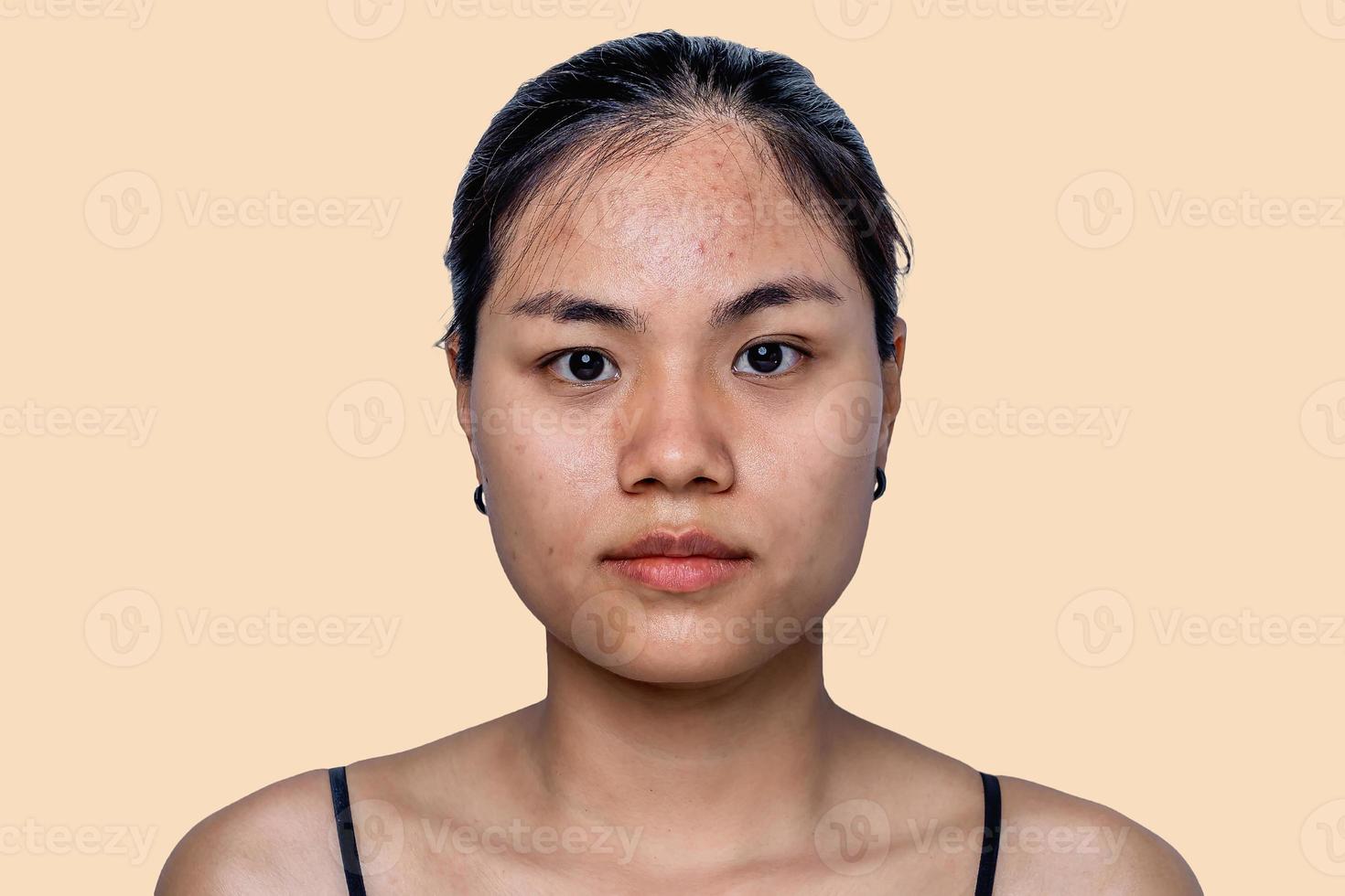 Young Asian woman worry about her face when she has problems with skin on her face in a natural background. Problems with acne and scar on the female skin. Problem skincare and health concept. photo