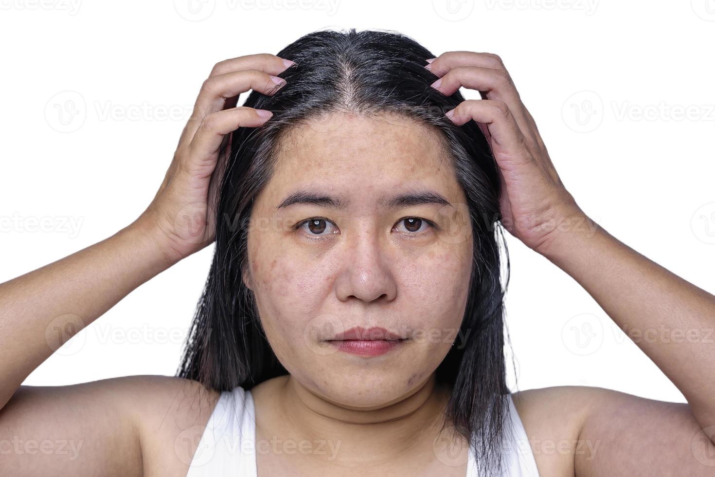 Asian adult woman face has freckles, large pores, blackhead pimple and scars problem from not take care for a long time. Skin problem face isolated white background. Treatment and Skincare concept photo