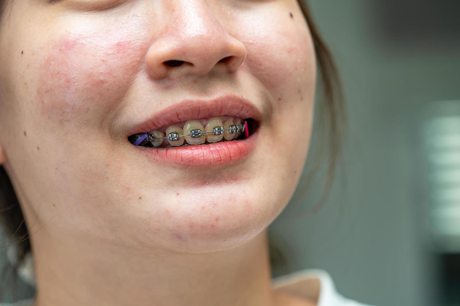 aparatos ortopédicos en la boca de una adolescente para tratar y embellecer para aumentar la confianza y la buena personalidad. foto