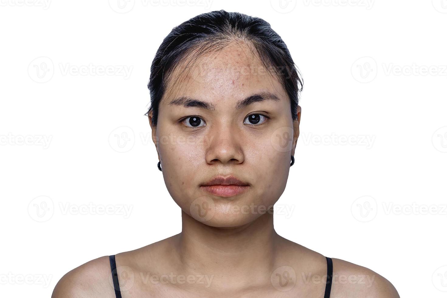 Young Asian woman worry about her face when she has problems with skin on her face in a natural background. Problems with acne and scar on the female skin. Problem skincare and health concept. photo
