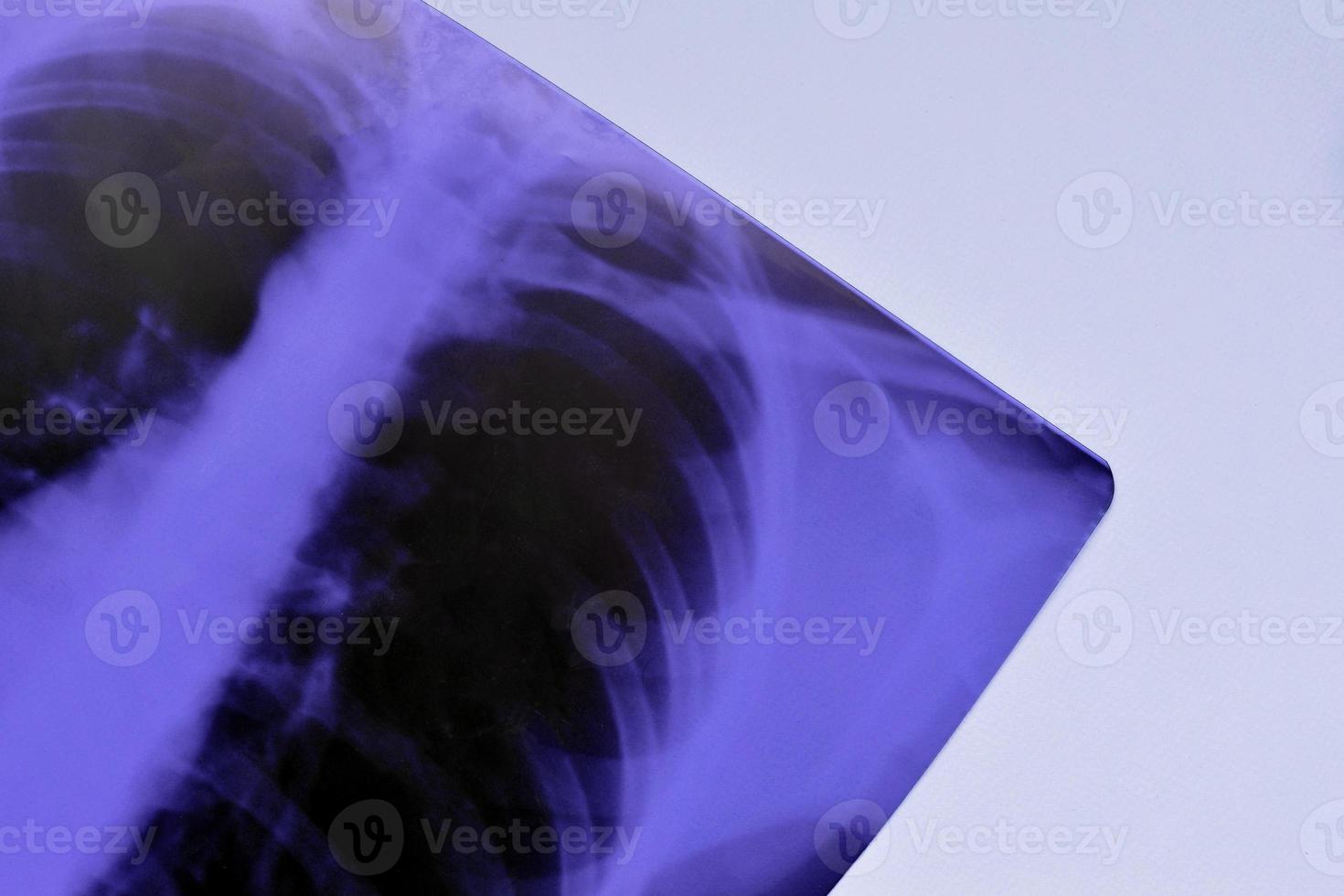 X-Ray film image of human chest for a medical diagnosis on blue hospital table. Flat lay top view photo