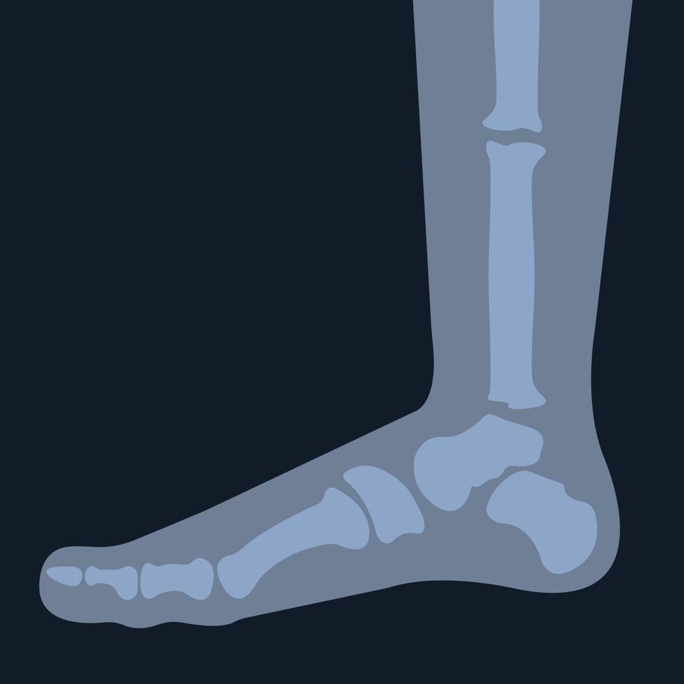 Upper radiograph of a human foot or limb. X-ray or radiographic image of the bones of the metatarsus and toes, viewed from above. Medical Radiology vector