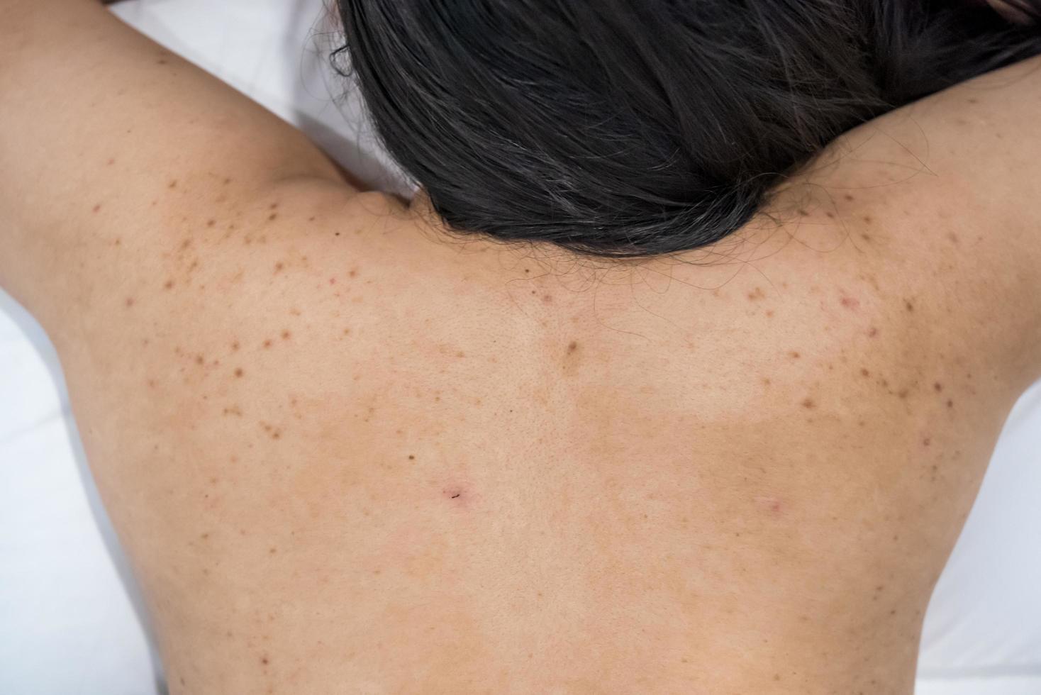 el acné en la parte posterior de la mujer del cuidado de la piel es causado por bacterias. foto