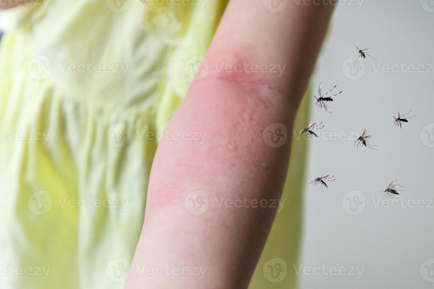 Little girl has skin rash allergy and itchy on her arm from mosquito bite photo