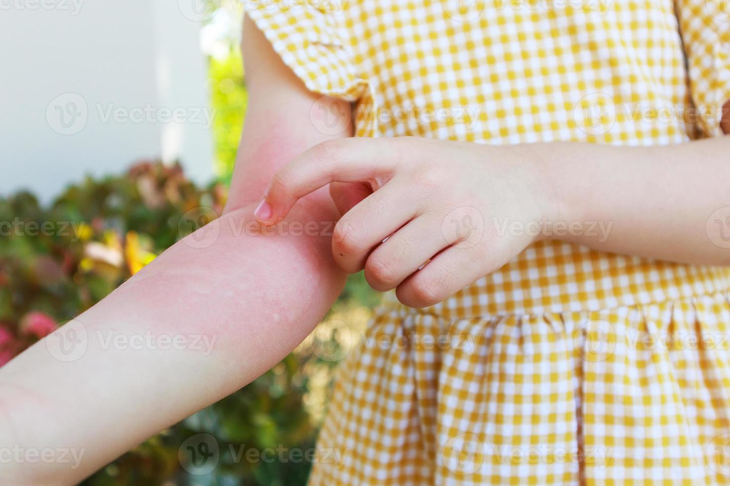 Little girl has skin rash allergy and itchy on her arm photo