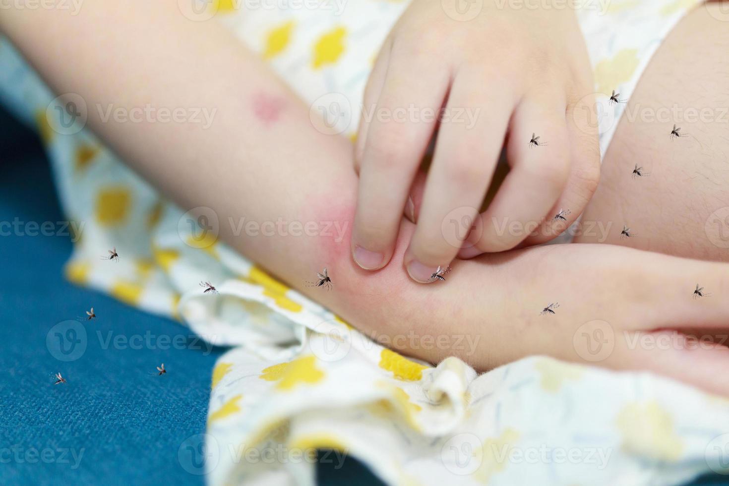 Little girl has skin rash allergy and itchy on her arm from mosquito bite photo