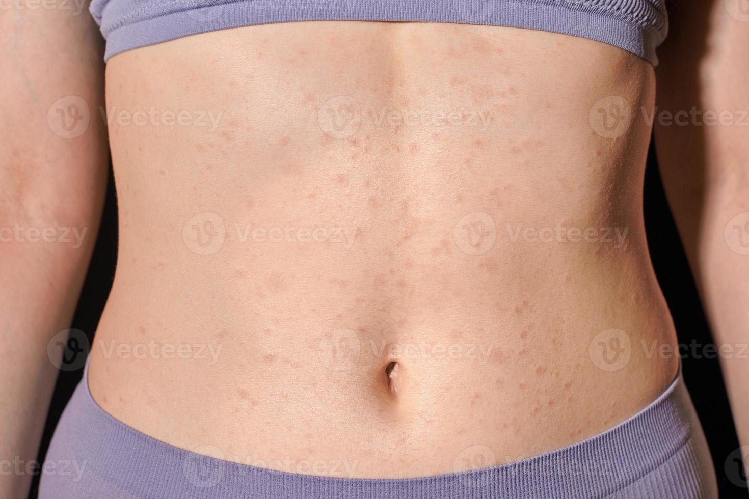 Red allergic rash on stomach skin, skin allergy, atopic dermatitis, eczema. Woman applying ointment photo