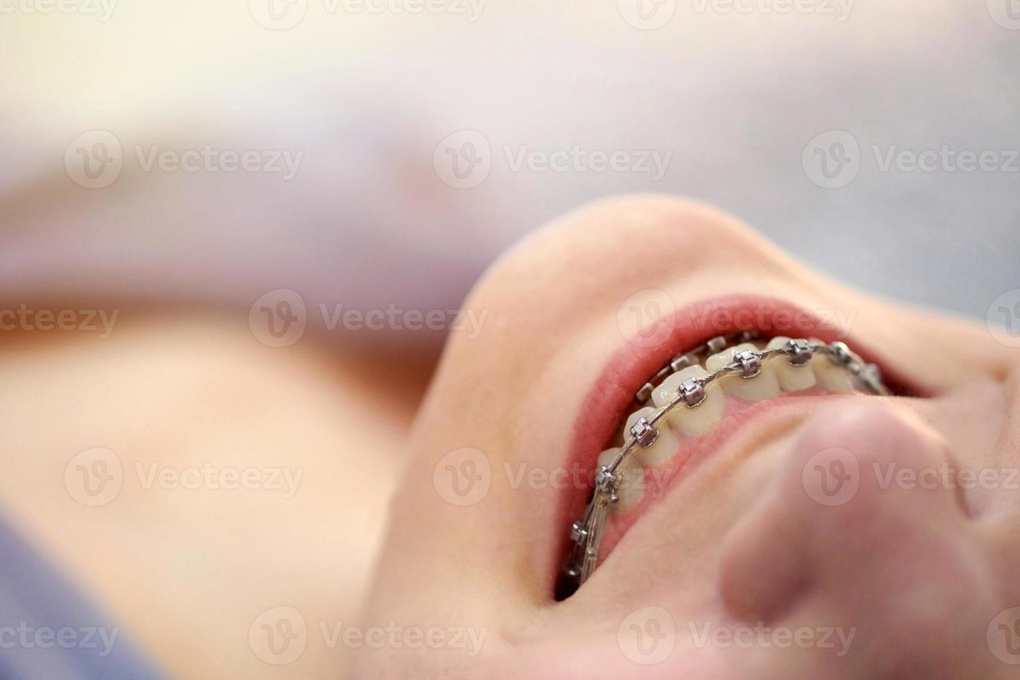 Smiling girl with braces close up. photo
